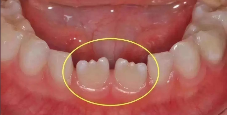 小牙齿为什么呈锯齿状？